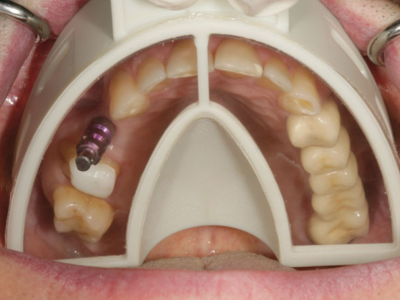 MIRATRAY Implant otisne žlice
