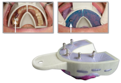 MIRATRAY Implant otisne žlice